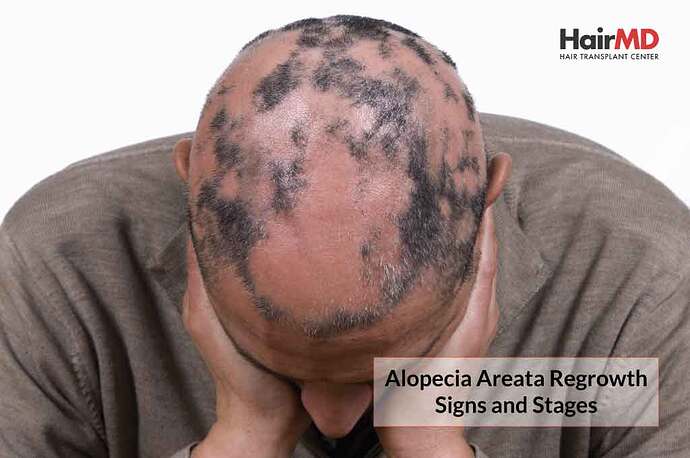 Alopecia-Areata-Regrowth-Signs-and-Stages